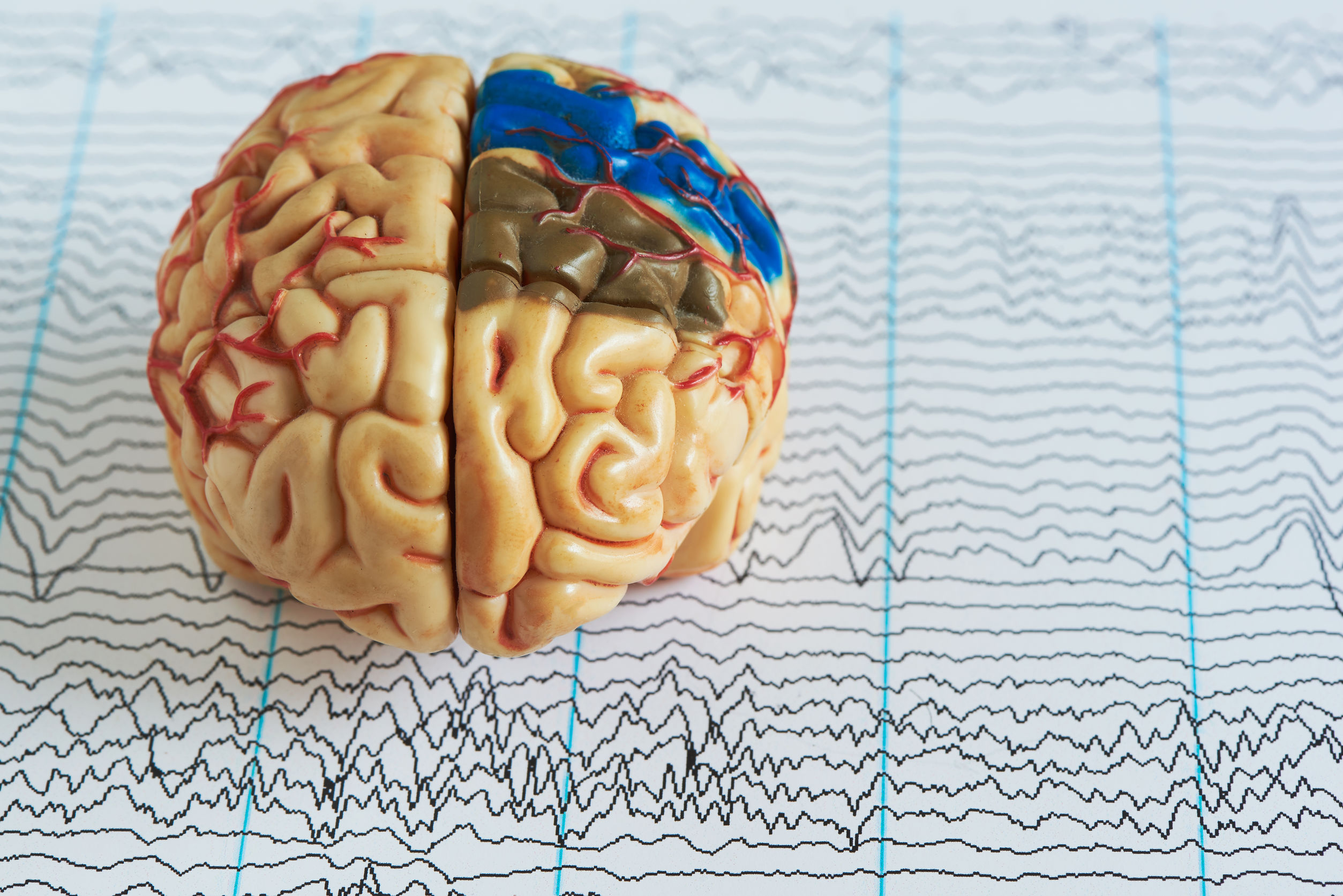 Er lijkt minstens verband tussen herpesvirus en Alzheimer – Wel.nl