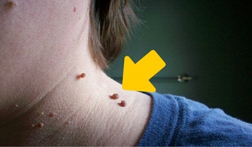 Zes natuurlijke manieren om skin tags te verwijderen - Gezonder leven