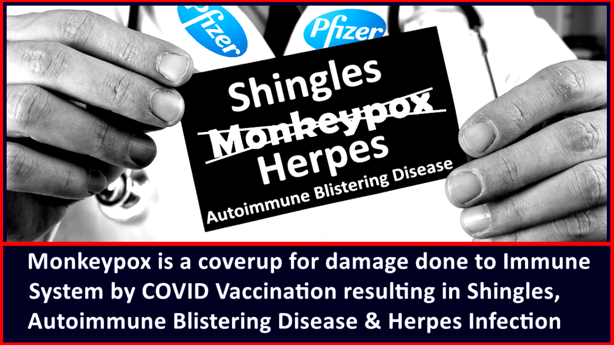 Monkeypox is a coverup for damage done to Immune System by COVID Vaccination resulting in Shingles, Autoimmune Blistering Disease & Herpes Infection – The Expose